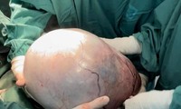 Choáng với khối u buồng trứng khổng lồ của người phụ nữ nghèo vừa được bác sĩ cắt bỏ