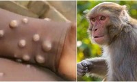 TPHCM khẩn cấp ứng phó bệnh đậu mùa khỉ
