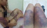 Các vết bầm tím khắp người chị Y do bị đánh đập tàn nhẫn. Ảnh: VietNamNet