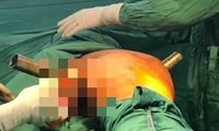 Nam thanh niên bị ống sắt đâm xuyên cơ thể sau vụ tai nạn kinh hoàng
