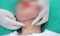 Cô gái nhập viện với vết cắt dài 15cm trên cổ