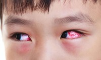 700 trẻ đau mắt đỏ nhập viện trong một tháng