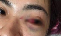 Nữ sinh lớp 11 bị đánh hội đồng dẫn đến tụ máu mắt