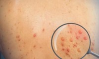 Du lịch Nam Phi về, người đàn ông Đắk Lắk nổi mụn đỏ, nghi mắc bệnh đậu mùa khỉ