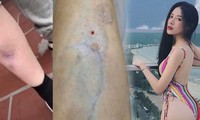 Hot girl bị teo cơ, giãn tĩnh mạch chân vì thẩm mỹ