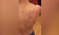 Phụ huynh tố cô giáo mầm non đánh con trai bầm tím lưng