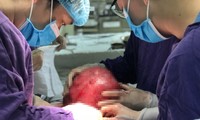 Các bác sĩ BV Ung bướu Hà Nội phẫu thuật cho bệnh nhân mang khối bướu khổng lồ. Ảnh: BV cung cấp