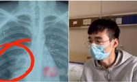 Cố hát một bài hát nhiều nốt cao, thanh niên Trung Quốc bị tổn thương phổi, suýt mất mạng