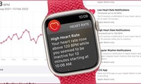 Apple Watch phát hiện được các triệu chứng về tuyến giáp vài tháng trước khi chẩn đoán?
