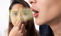 Cách giúp bạn giải quyết triệt để rắc rối vụ hơi thở “có mùi” khiến cuộc đời mãi F.A