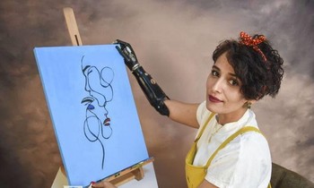 4 lần thoát chết, cô gái trẻ vẫn vững tin vào cuộc sống với cánh tay giả là bạn đồng hành