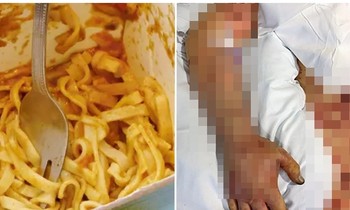 Nam sinh ăn mì gà để tủ lạnh qua đêm của bạn cùng phòng, phải phẫu thuật bỏ chân tay