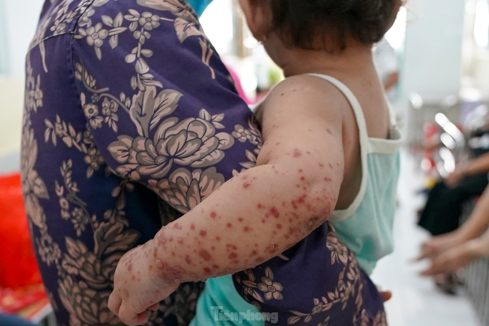 Vào 'điểm nóng' đang điều trị hàng trăm trẻ mắc tay chân miệng ở TPHCM ảnh 9