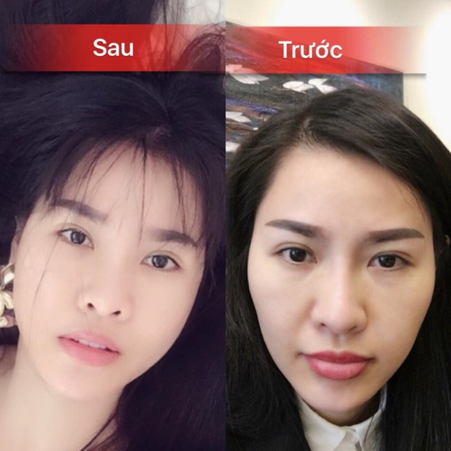 Quế Vân công khai ảnh phẫu thuật toàn bộ gương mặt ở Hàn Quốc ảnh 1