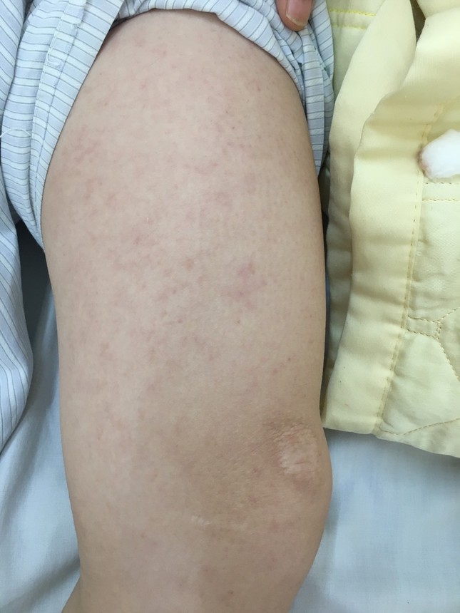 Bay từ TP. HCM ra, thanh niên Hà Nội nguy kịch vì sởi biến chứng ảnh 1