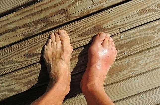 Những dấu hiệu khác thường trên bàn chân cho thấy sức khỏe của bạn đang ‘kêu cứu’ ảnh 2