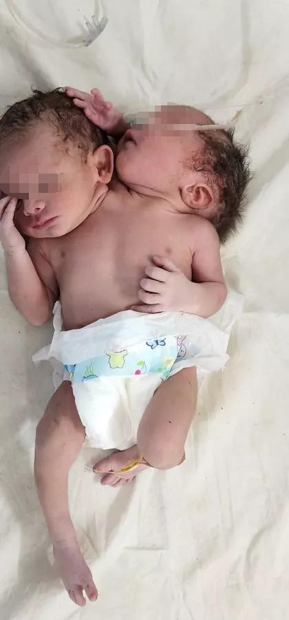 Hy hữu: Em bé hai đầu, ba tay chào đời ở Ấn Độ ảnh 1