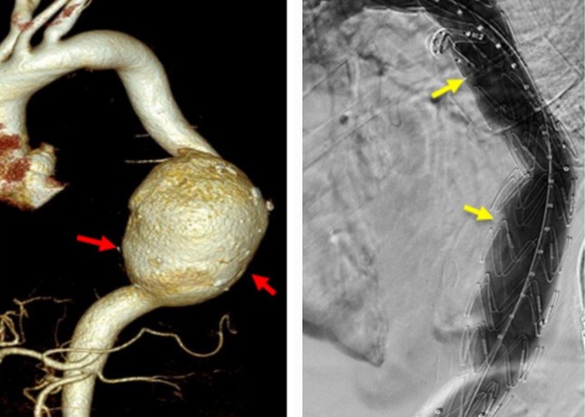 Cứu bệnh nhân nước ngoài bị vỡ túi phình động mạch chủ khổng lồ ảnh 1