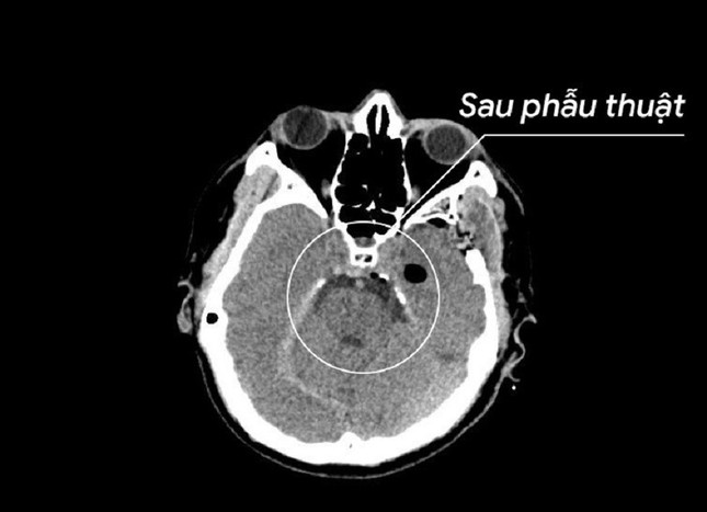 Phóng đại khối u lên 25 lần, cứu người đàn ông mắc bệnh hiếm gặp ảnh 3