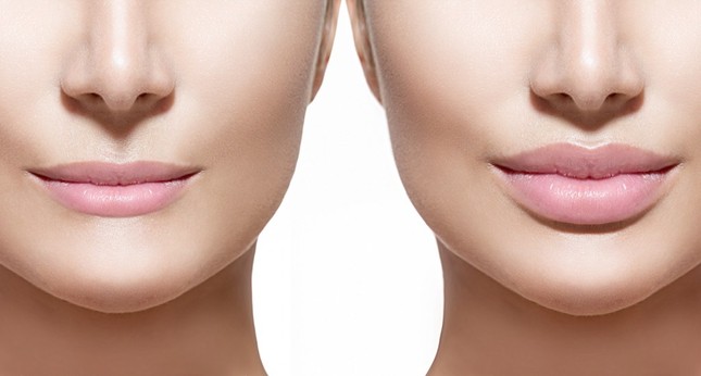 Tại sao mọi người đều tiêm filler làm đầy môi? Những khao khát dấu đằng sau mốt môi dày ảnh 2