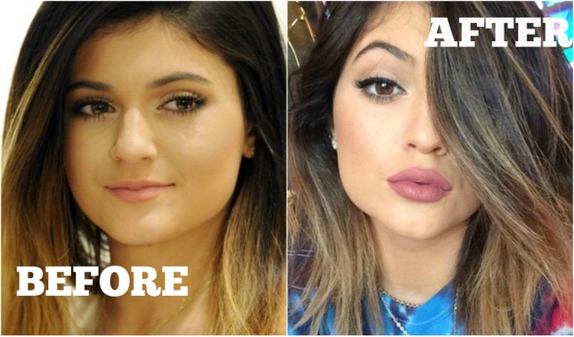 Tại sao mọi người đều tiêm filler làm đầy môi? Những khao khát dấu đằng sau mốt môi dày ảnh 4