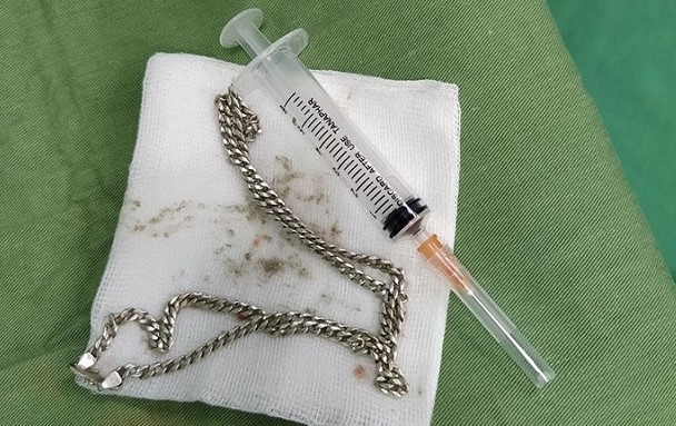 Bé 29 tháng tuổi nuốt sợi dây chuyền vào bụng ảnh 1