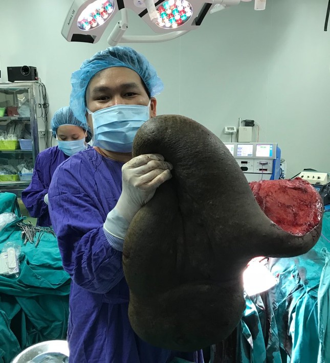 Cắt khối u khổng lồ... 15kg trên lưng nam bệnh nhân ảnh 2