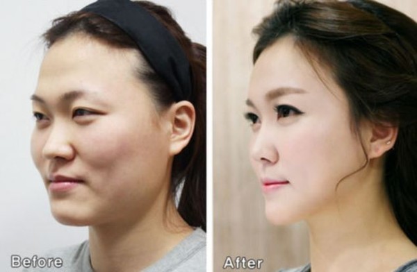 Dở khóc dở cười với các cô nàng 'vịt hóa thiên nga' sau thẩm mỹ ảnh 1