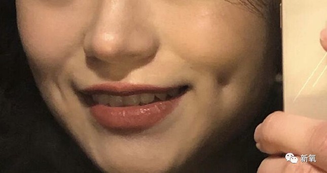 Cô gái trẻ 17 đóng đinh vào má để có má lúm đồng tiền như diễn viên Lê Tư ảnh 2