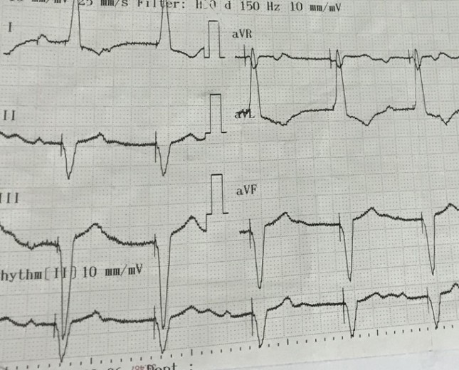 Bệnh viện Chợ Rẫy đặt máy tạo nhịp tim không dây thành công ảnh 3