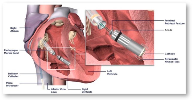 Bệnh viện Chợ Rẫy đặt máy tạo nhịp tim không dây thành công ảnh 5