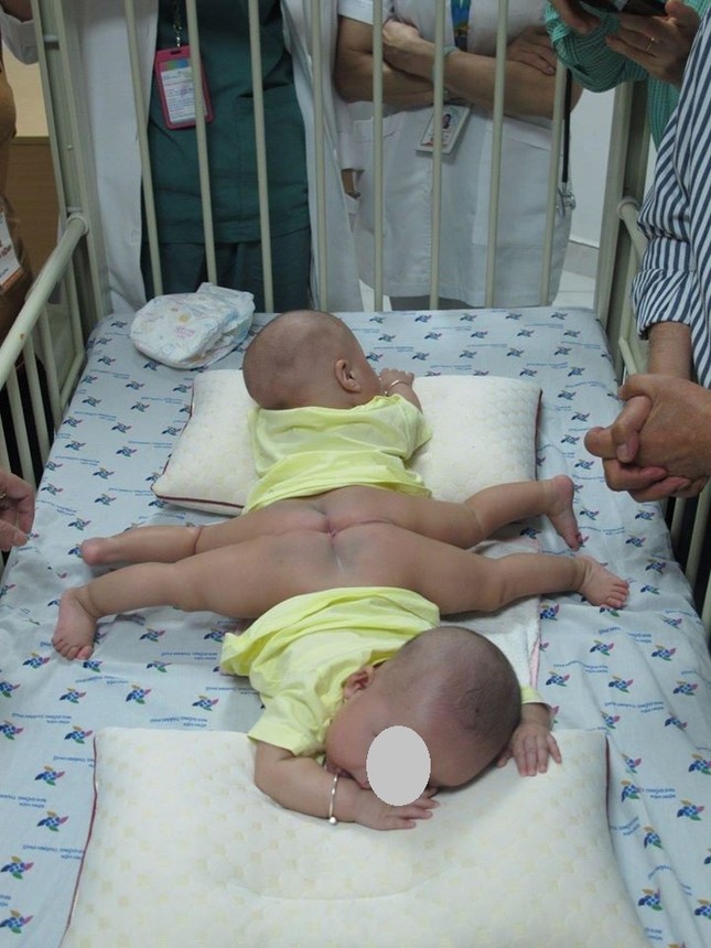 TPHCM: Chuẩn bị tách ca song sinh dính liền 'dùng chung một tã' ảnh 2