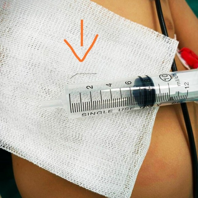 Tưởng bé ăn dặm hóc xương, bác sĩ gắp ra vật không ngờ ảnh 2