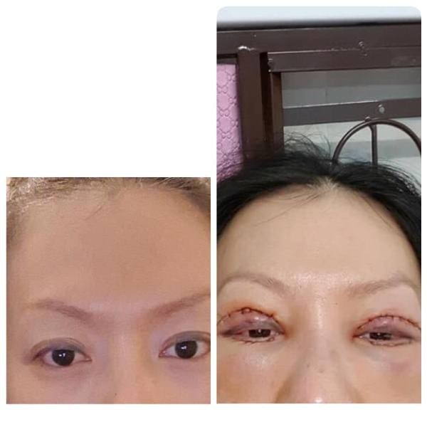 Thẩm mỹ ở cơ sở 'dỏm', đau đớn vì mắt không thể nhắm kín ảnh 1