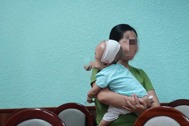 Mẹ phát hoảng vì đầu con ngày càng to do biến dạng sọ ảnh 3