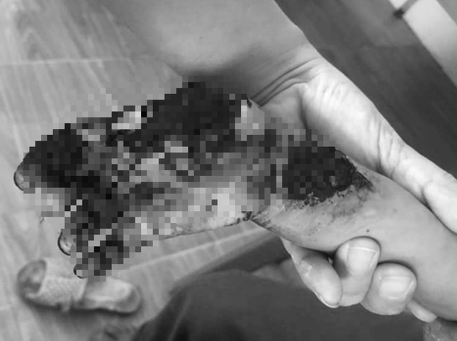 Cầm đầu dây sạc điện thoại, bé 3 tuổi bị giật cháy tay ảnh 1