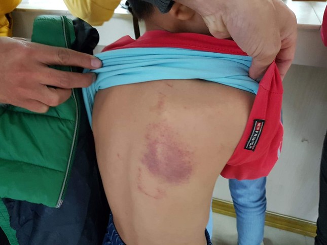Bé trai lớp 2 bị cô giáo chủ nhiệm đánh bầm tím người ảnh 1