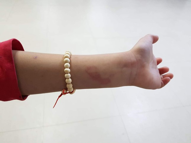 Bé trai lớp 2 bị cô giáo chủ nhiệm đánh bầm tím người ảnh 2