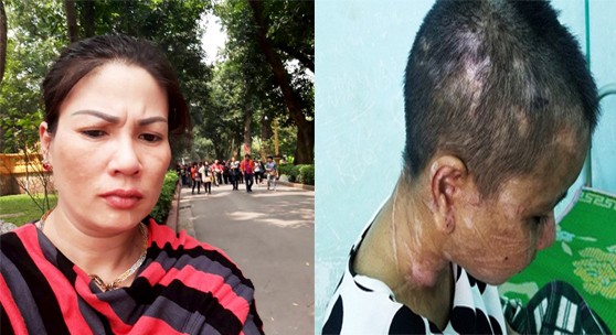 Bà Nguyễn Thị Hà tra tấn người giúp việc Y Nhiêu đến