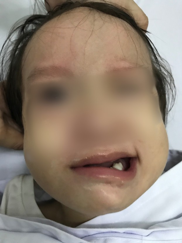Bé gái 17 tháng tuổi đột ngột liệt mặt sau khi chảy mũi, ngạt mũi ảnh 1