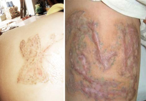 Hãi hùng công nghệ xóa hình xăm, xua vận rủi của dân chơi ảnh 1