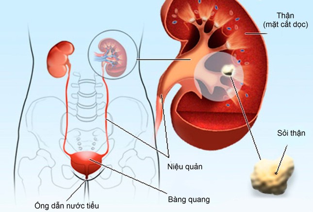 Ngăn ngừa biến chứng khó lường của sỏi tiết niệu ảnh 1