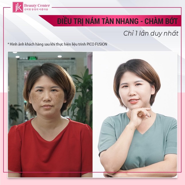 Bí quyết trị nám của U30 Hà Thành khiến chị em ngỡ ngàng ảnh 2