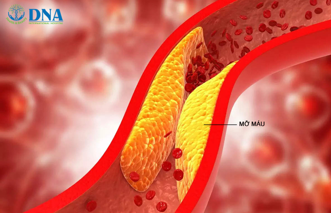Lọc máu ngừa đột quỵ ảnh 1