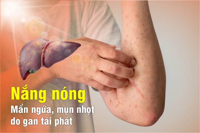 Nắng nóng – Mẩn ngứa, mụn nhọt do gan tái phát ảnh 1