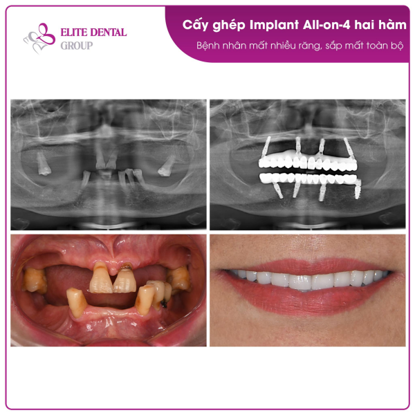 Đột phá mới trong trồng răng Implant cho người lớn tuổi ảnh 2