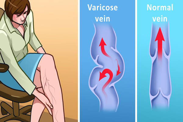 TPBVSK Dulcit – Chất lượng sản phẩm thảo dược đến từ Pháp bảo vệ tĩnh mạch chân ảnh 1
