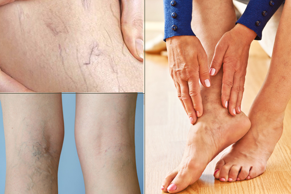 TPBVSK Dulcit – Chất lượng sản phẩm thảo dược đến từ Pháp bảo vệ tĩnh mạch chân ảnh 2