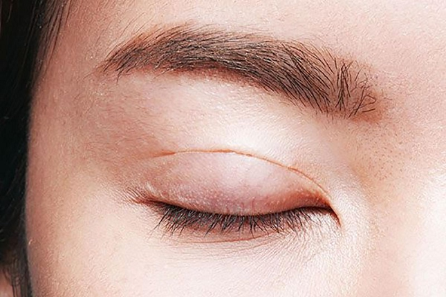 Cắt mí hay nhấn mí, đâu là lựa chọn tốt nhất? ảnh 1