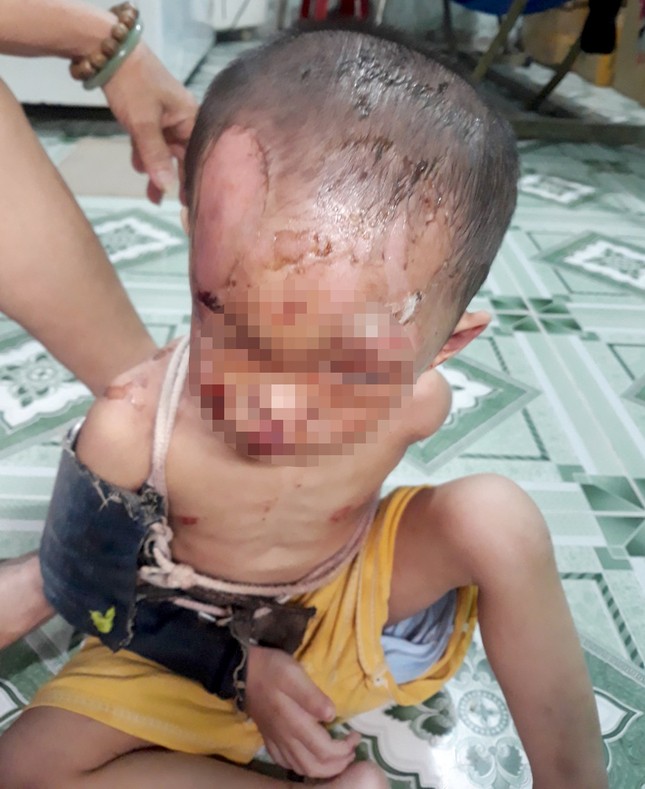 Nghi vấn bé trai ở TPHCM bị cha mẹ đánh đập dã man, trên người đầy vết thương ảnh 2